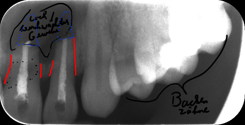 Röntgenbild meiner Zähne