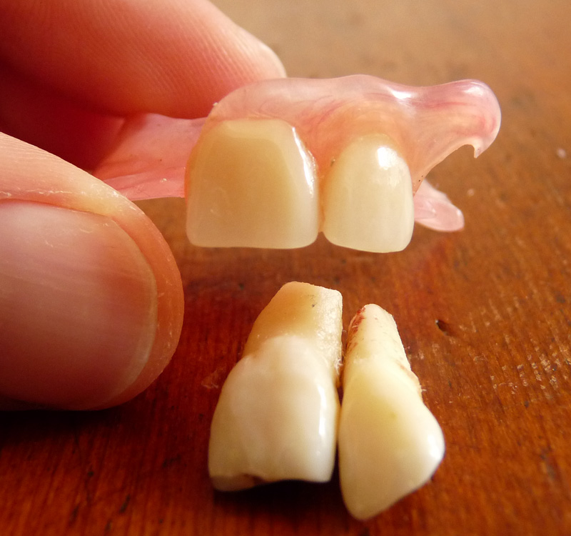 Valplast Prothese vs Zähne